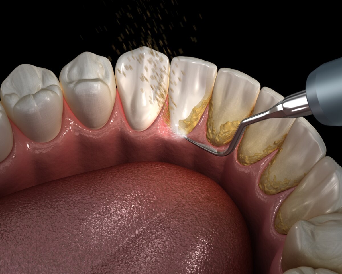 Teeth Cleaning