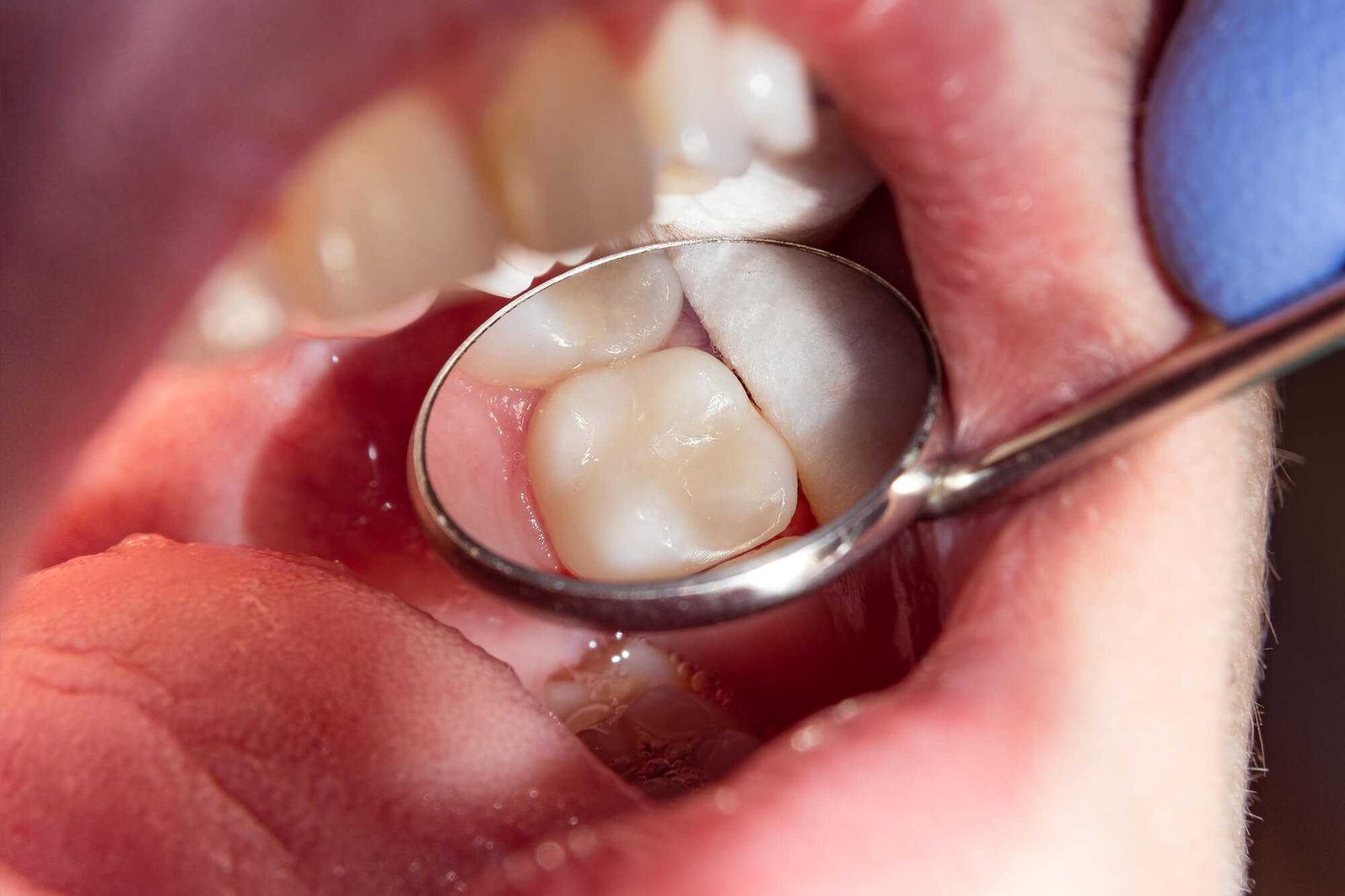 Tooth Color Filling